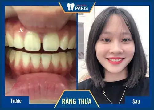 Tướng Răng Nhỏ Đều Tướng Răng Nhỏ Đều
