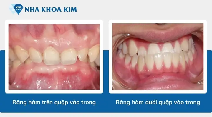 Tướng Răng Quặp Vào Trong