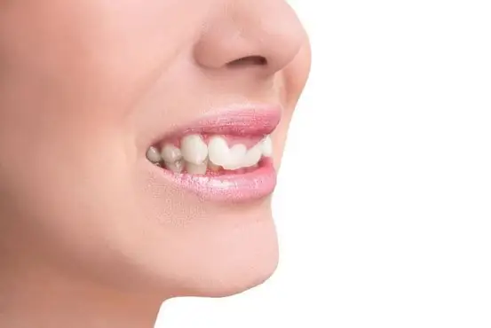 Tướng Răng Quặp Vào Trong
