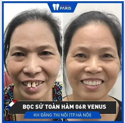 Tướng Răng Quỷ