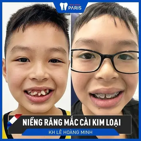 Tướng Răng Quỷ