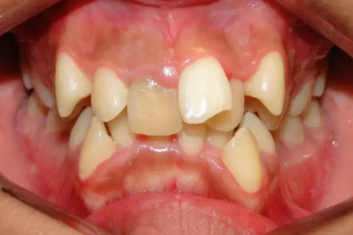 Tướng Răng Xấu