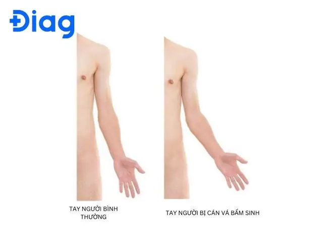 Tướng Tay Cán Vá