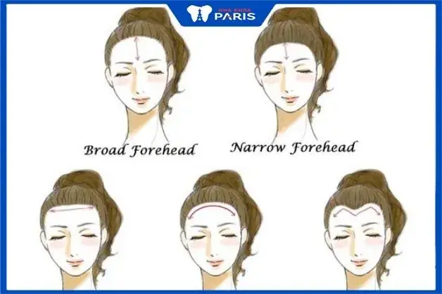 Tướng Trán Trợt