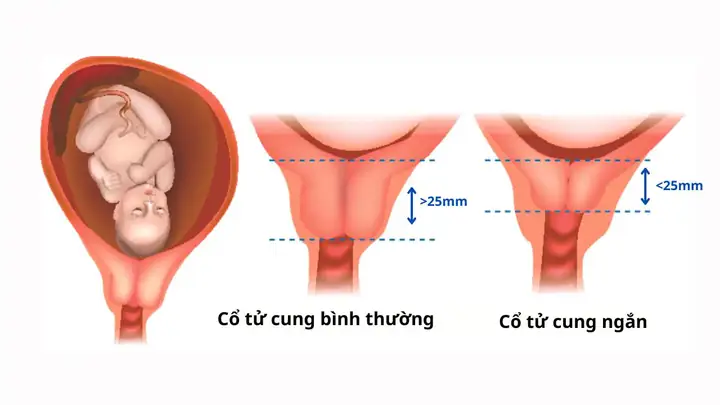 Ử Vi Tướng Số Cổ Ngắn Cổ Dài Ử Vi Tướng Số Cổ Ngắn Cổ Dài