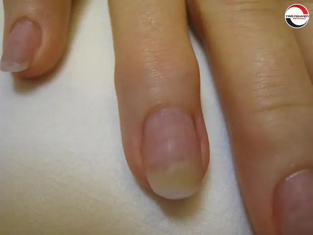 Xem Bói Điềm Trắng Trên Móng Tay