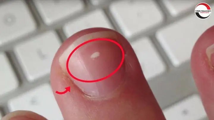 Xem Bói Điềm Trắng Trên Móng Tay