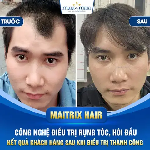Xem Tướng Đàn Ông Đầu Hói