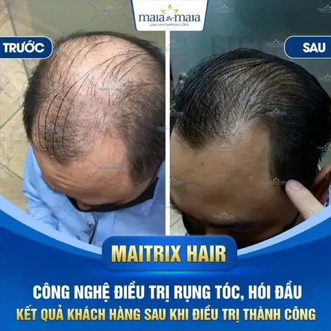 Xem Tướng Đàn Ông Đầu Hói