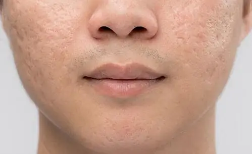 Xem Tướng Đàn Ông Mặt Rỗ