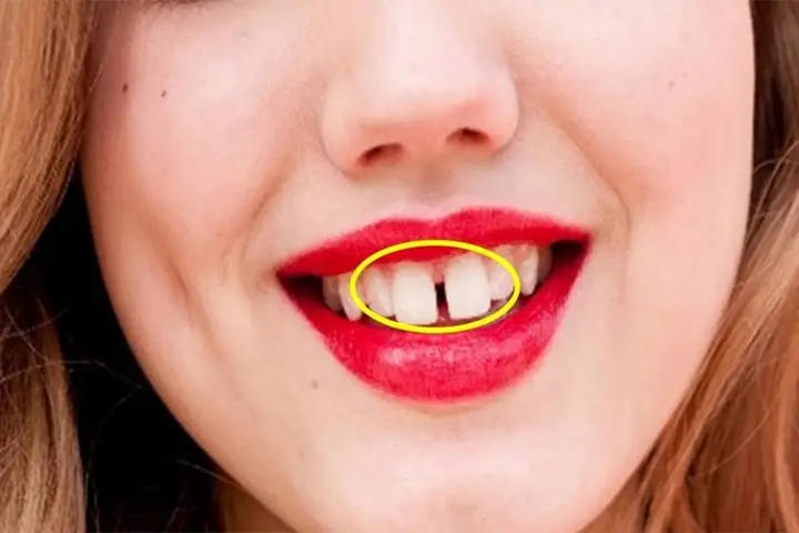 Xem Tướng Đàn Ông Răng Cửa Thưa